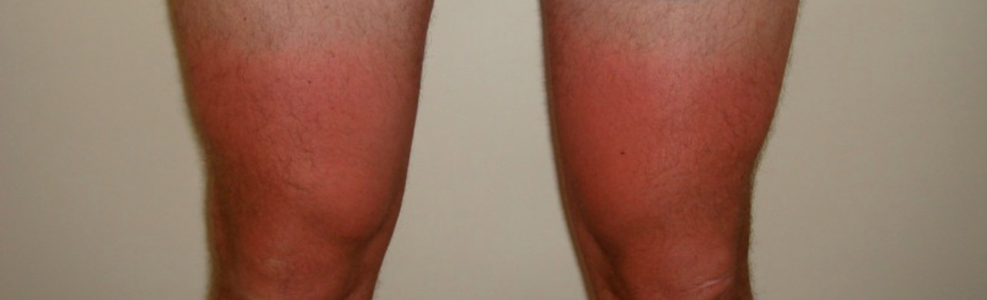 Does Getting A Suntan Really Protect Against Burns That Cause Skin Cancer 